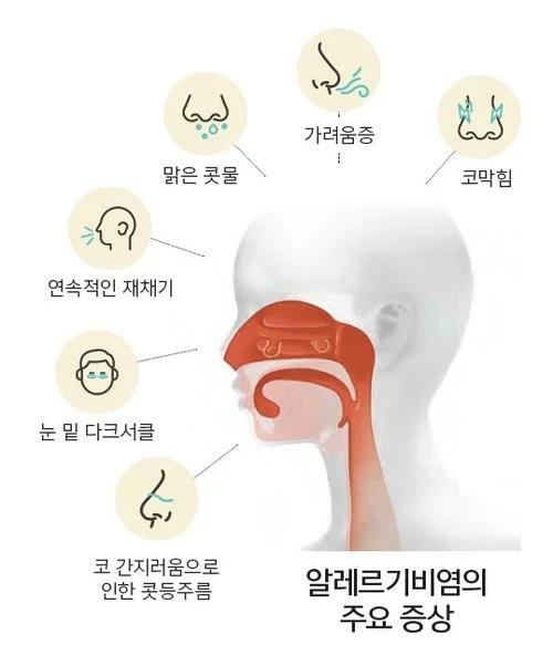 알레르기비염