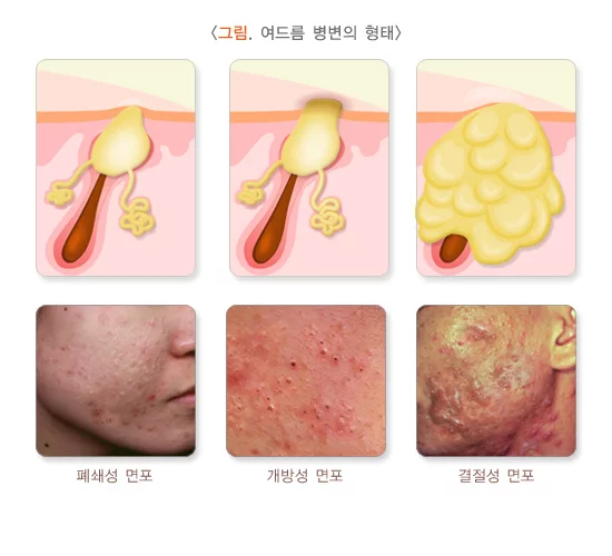 여드름이 나는 이유
