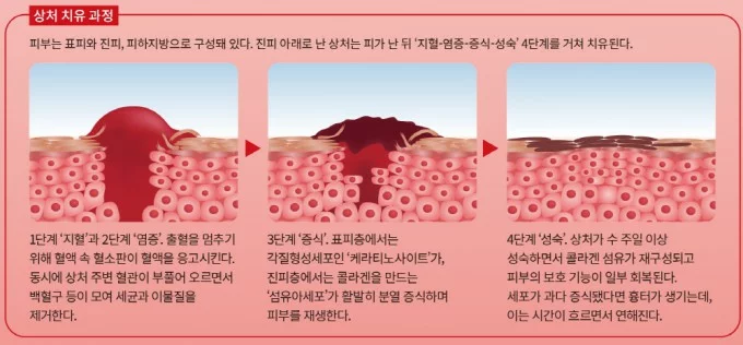 상처의 회복 과정