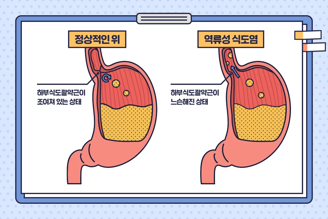 역류성 식도염